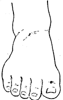 足大趾横纹 